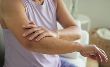 Kako se nositi s ekcemom u menopauzi Učinite ovo