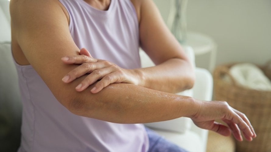 Kako se nositi s ekcemom u menopauzi Učinite ovo
