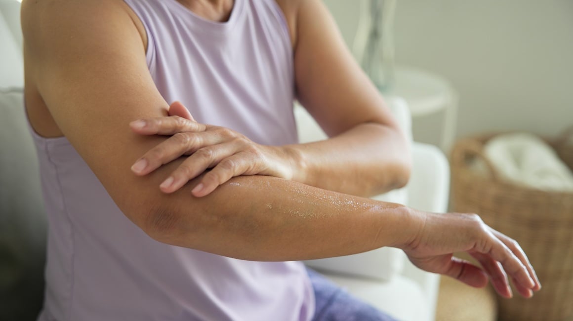 Kako se nositi s ekcemom u menopauzi Učinite ovo