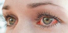 Konjunktivitis