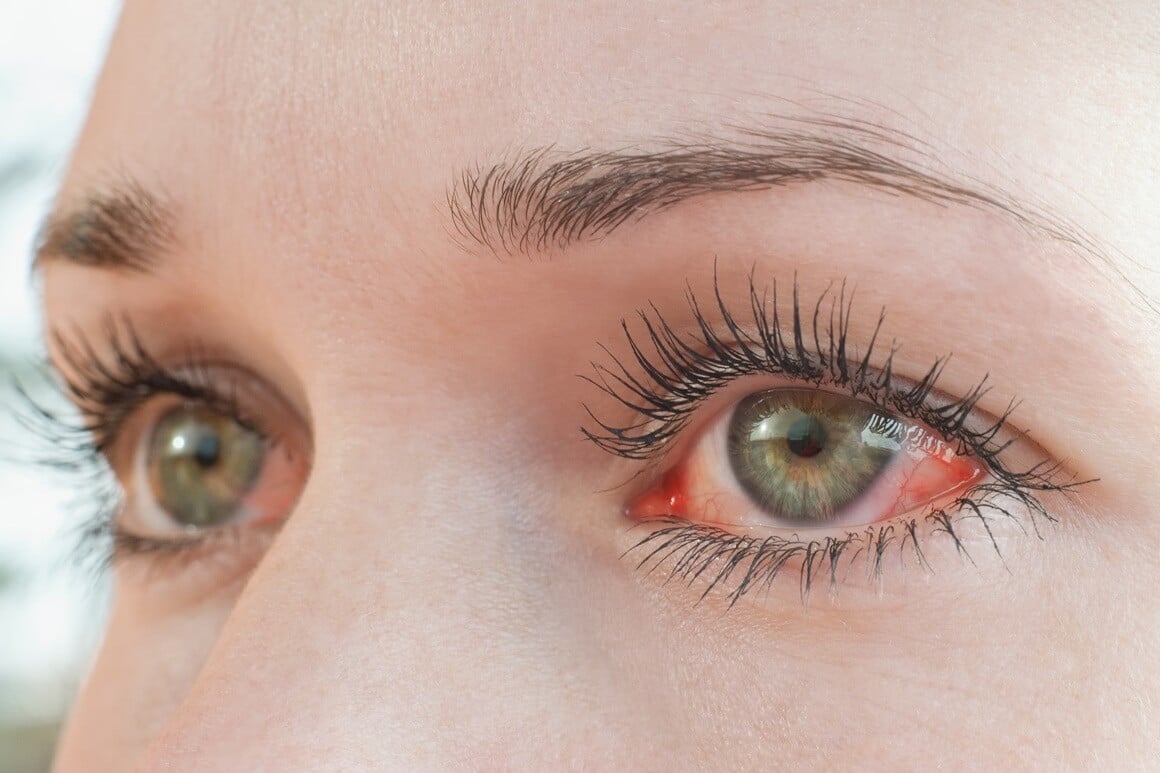 Konjunktivitis