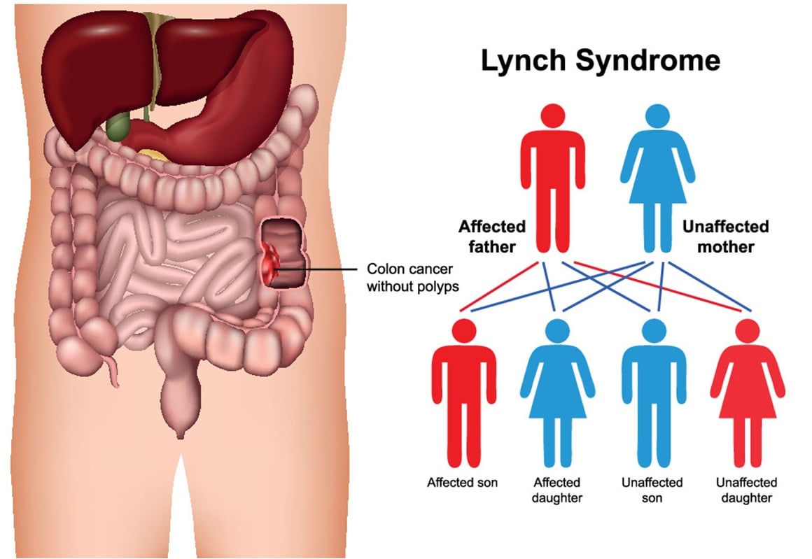 Lynchov sindrom