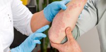 Osobe sa psorijazom imaju povećani rizik od drugih kroničnih bolesti