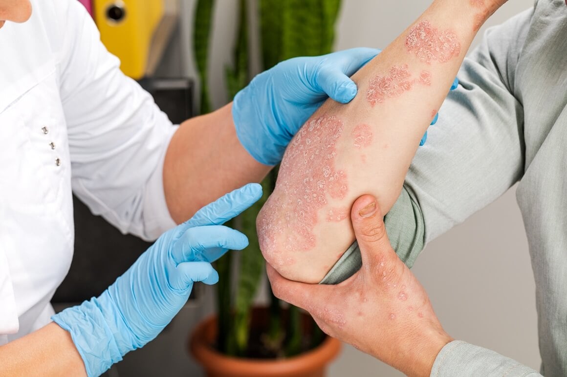 Osobe sa psorijazom imaju povećani rizik od drugih kroničnih bolesti