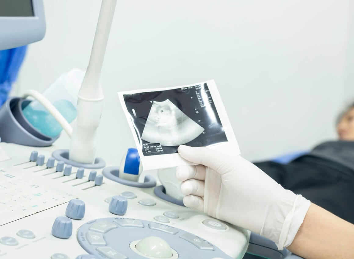 Placenta previja u trudnoći
