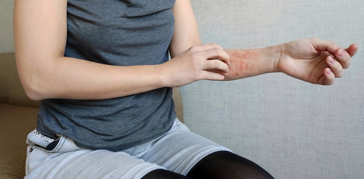 Psorijaza i problemi sa snom