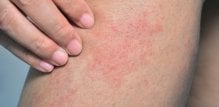 Simptomi ekcema i menopauze