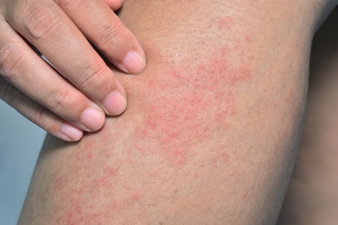 Simptomi ekcema i menopauze