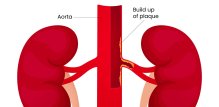 Stenoza bubrežne arterije