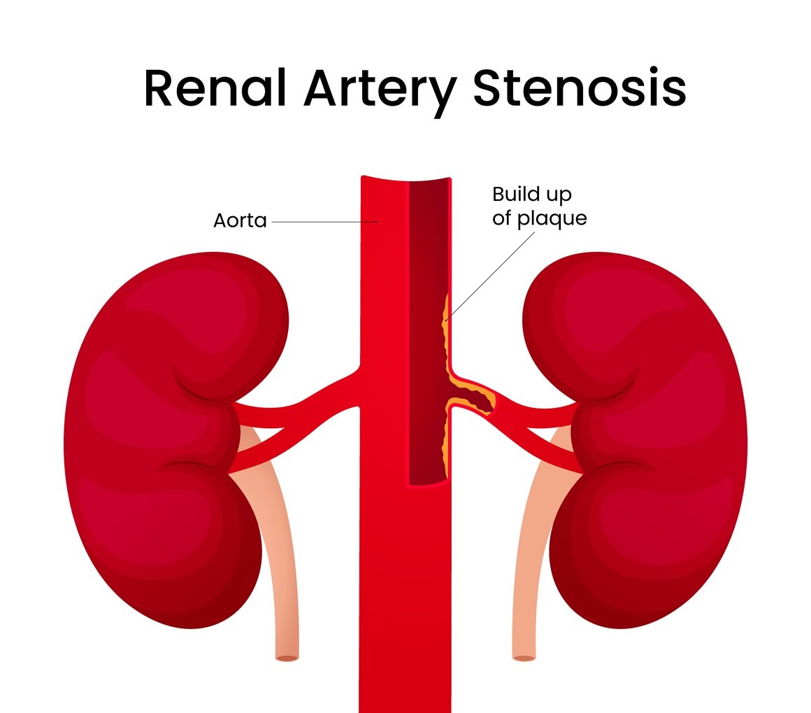 Stenoza bubrežne arterije