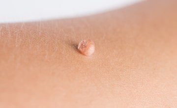 Viseće bradavice (viseći fibromi) Što su i kako nastaju