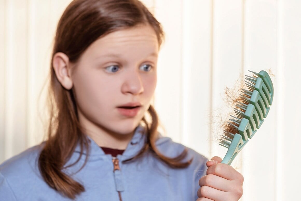 alopecija kod djece