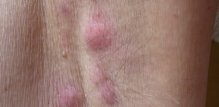 hidradenitis suppurativa