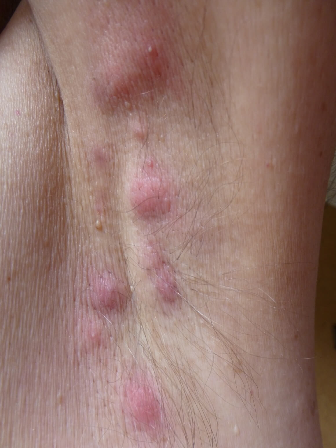 hidradenitis suppurativa