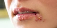 spolno prenosive bolesti oralno