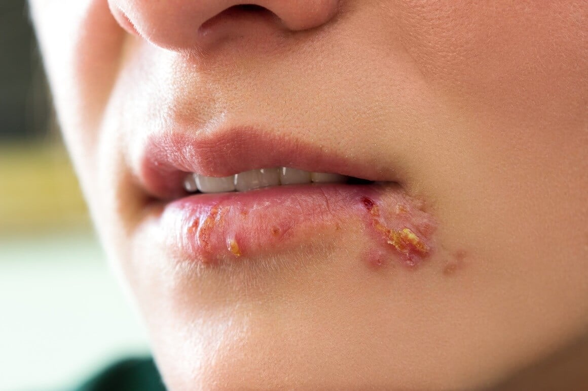 spolno prenosive bolesti oralno