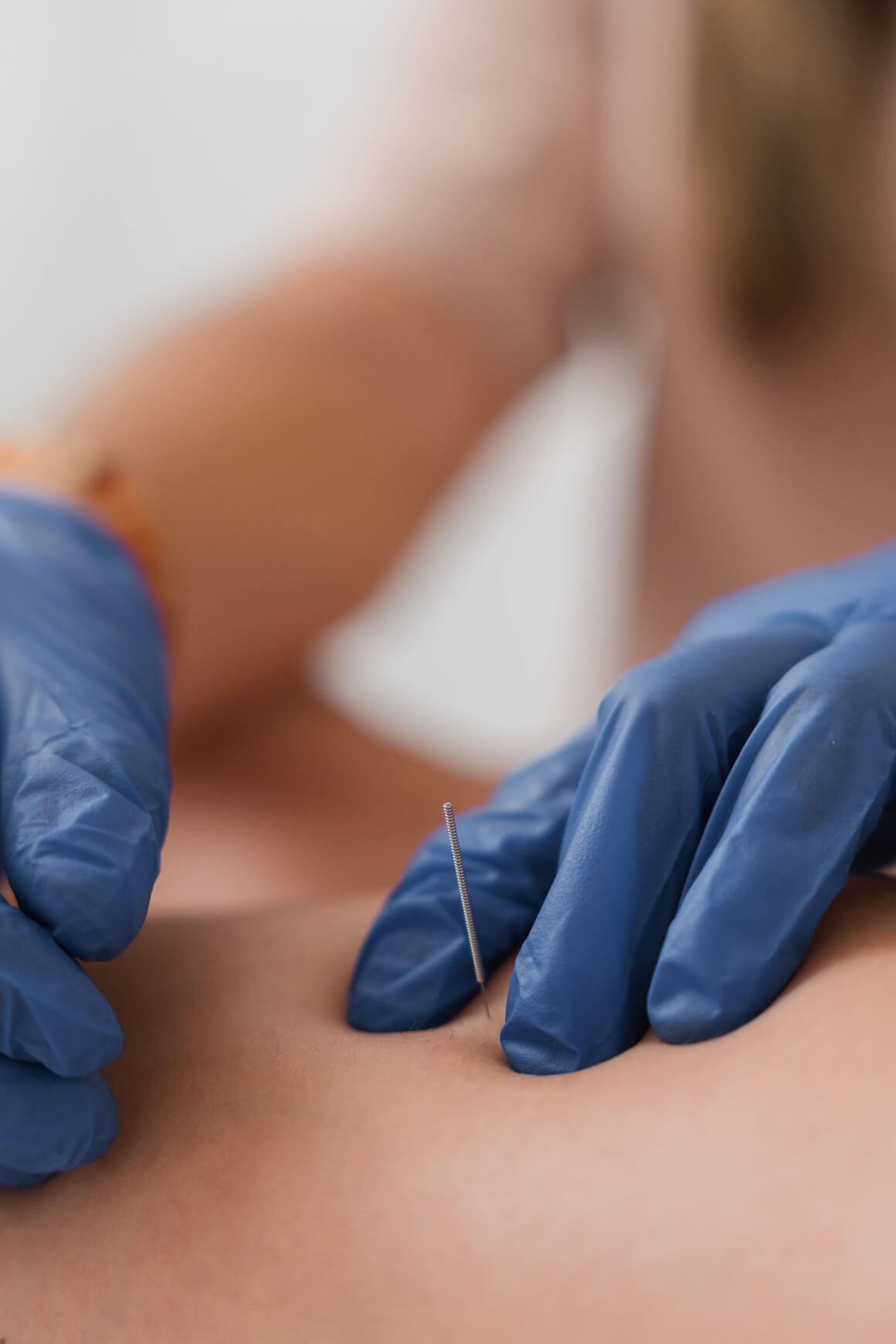 Dry needling