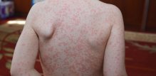 Epstein-Barr virus - simptomi kod djece