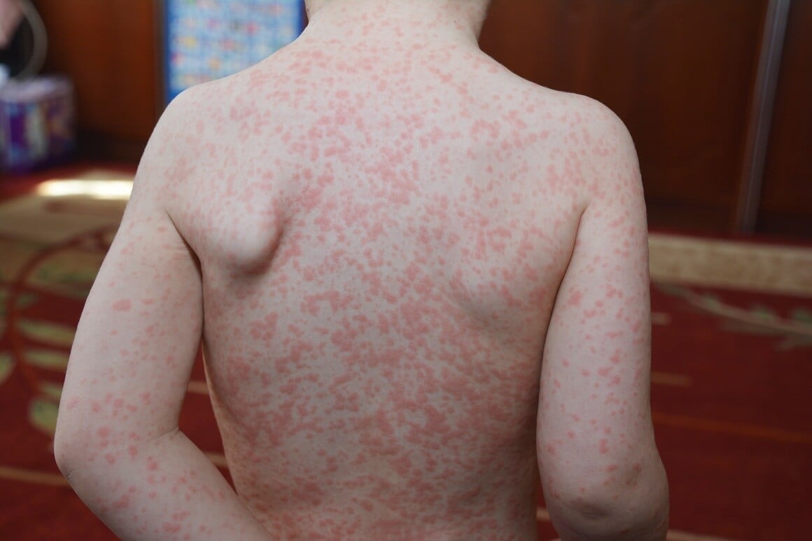 Epstein-Barr virus - simptomi kod djece