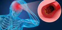 Faktori rizika za nastanak cerebrovaskularnih bolesti