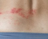 Herpes zoster se očituje kao osip u obliku uzdignutih točkica koje se pretvaraju u bolne mjehuriće