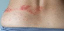Herpes zoster se očituje kao osip u obliku uzdignutih točkica koje se pretvaraju u bolne mjehuriće