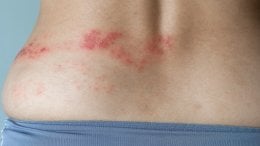 Herpes zoster se očituje kao osip u obliku uzdignutih točkica koje se pretvaraju u bolne mjehuriće