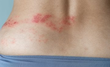 Herpes zoster se očituje kao osip u obliku uzdignutih točkica koje se pretvaraju u bolne mjehuriće
