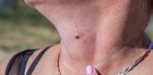 Iako UV zračenje uzrokuje većinu slučajeva raka kože, genetika također ima svoju ulogu
