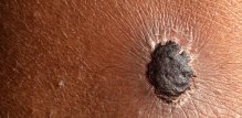 Iako melanom čini svega 1 % svih dijagnoza raka kože, odgovoran je za većinu smrtnih ishoda