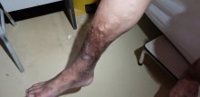 Kronična venska insuficijencija - simptomi