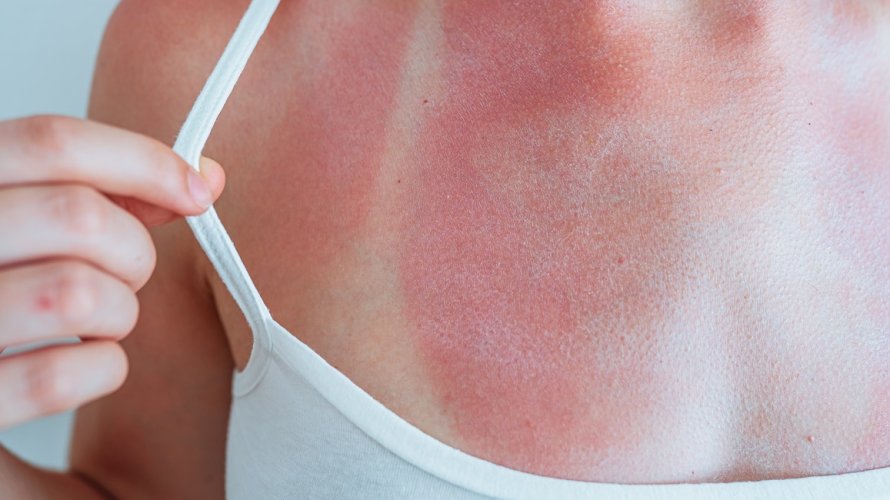 Nakon ljetnog dana provedenog na suncu vaša koža može postati osjetljiva, crvena i bolna