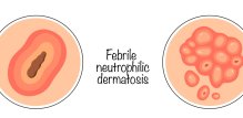 Neutrofilne dermatoze su skupina kožnih bolesti koje nastaju zbog nakupljanja neutrofila (vrste bijelih krvnih stanica) u koži uslijed kronične upale