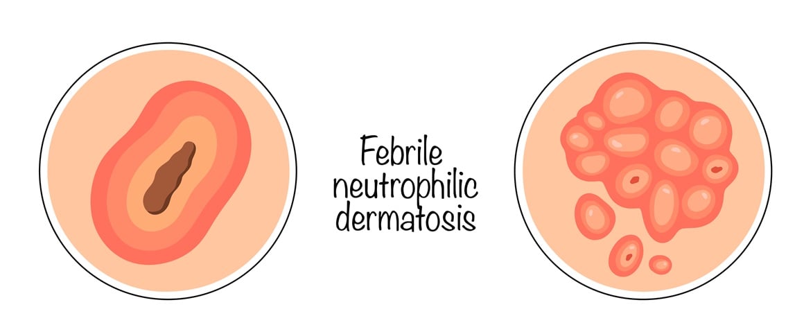 Neutrofilne dermatoze su skupina kožnih bolesti koje nastaju zbog nakupljanja neutrofila (vrste bijelih krvnih stanica) u koži uslijed kronične upale