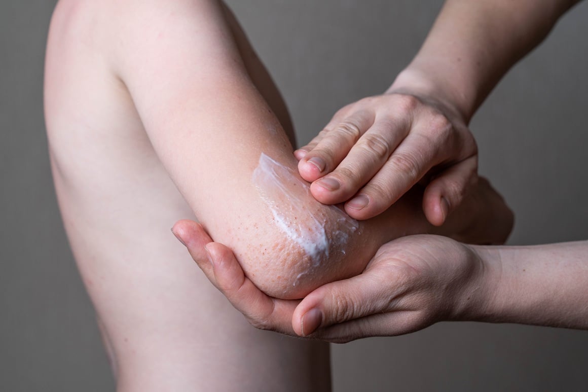 Novi lijekovi brišu simptome atopijskog dermatitisa bez nuspojava