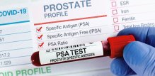 PSA test - rezultati
