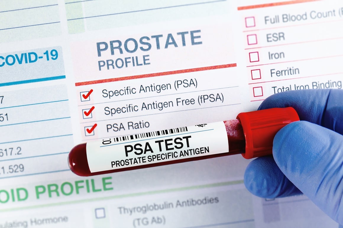 PSA test - rezultati