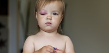 Periorbitalni celulitis je bakterijska infekcija kože oko oka, osobito vjeđa, koja najčešće pogađa djecu
