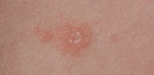 Pityriasis rosea je bezopasni osip koji počinje kao ružičasta ljuskava mrlja, a zatim se širi u obliku božićnog drvca