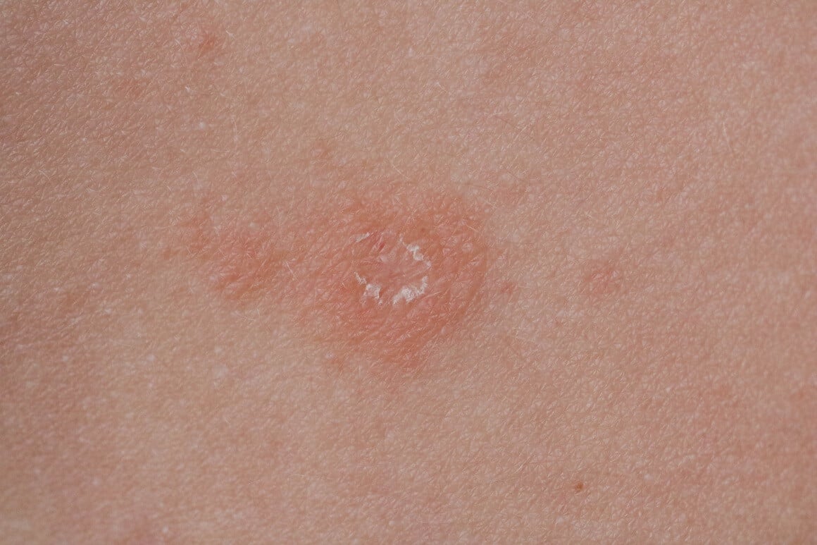 Pityriasis rosea je bezopasni osip koji počinje kao ružičasta ljuskava mrlja, a zatim se širi u obliku božićnog drvca