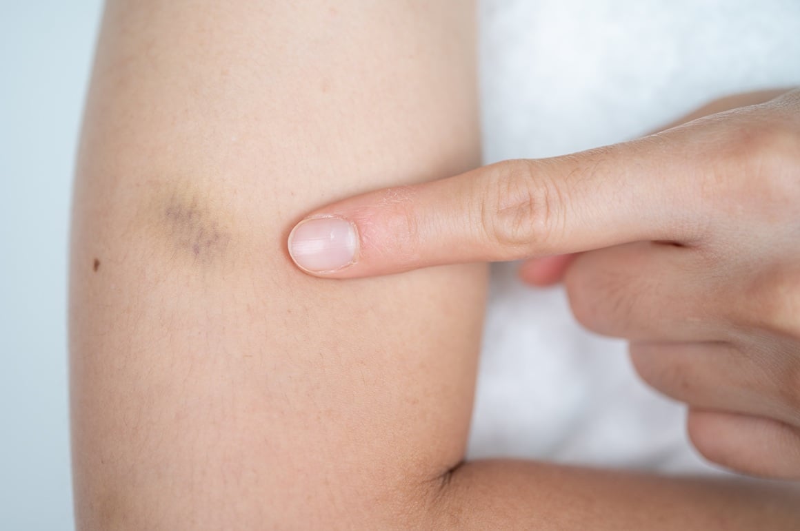 Reumatoidni artritis može uzrokovati smanjenje broja trombocita, stanica koje su ključne za zgrušavanje krvi