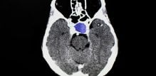 Tumor hipofize može uzrokovati poremećaj u lučenju hormona