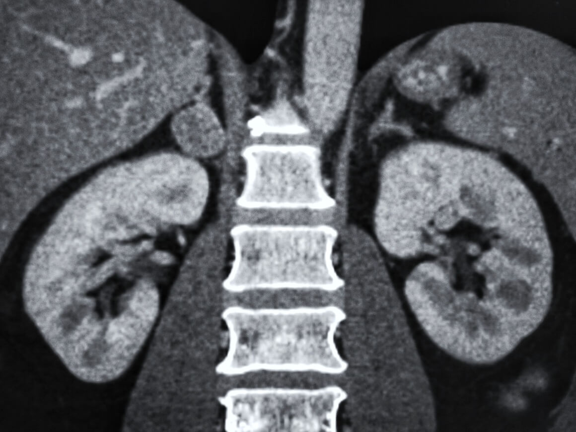 Tumor nadbubrežne žlijezde