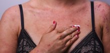 Većina pacijenata s atopijskim dermatitisom svoj put liječenja započinje steroidnim kremama na recept