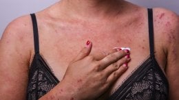 Većina pacijenata s atopijskim dermatitisom svoj put liječenja započinje steroidnim kremama na recept