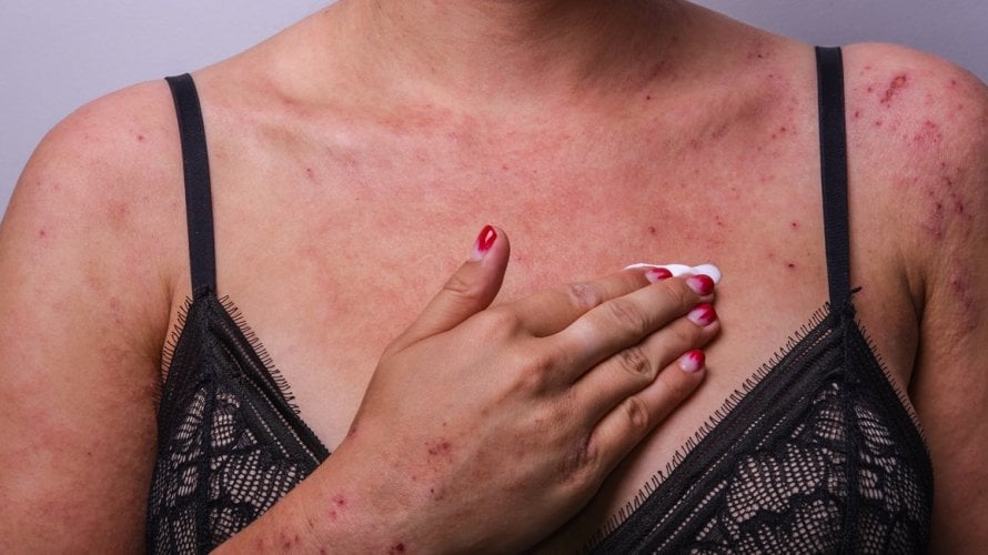 Većina pacijenata s atopijskim dermatitisom svoj put liječenja započinje steroidnim kremama na recept