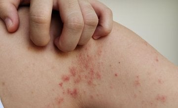 bakterijska infekcija kože
