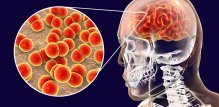 meningokokni meningitis, simptomi