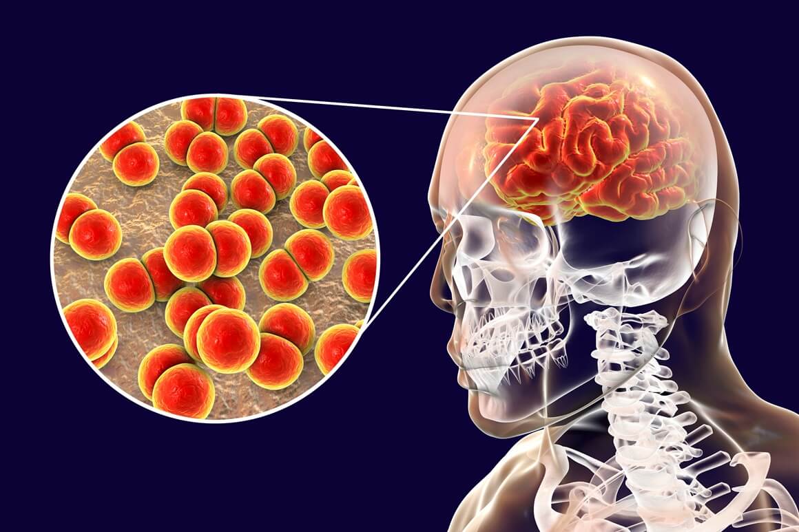 meningokokni meningitis, simptomi