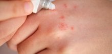nova krema za dermatitis šaka